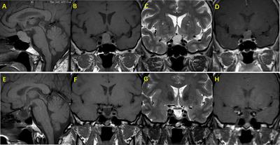 Analysis of the Clinical Characteristics and Pituitary Function of Patients in Central China With Rathke’s Cleft Cysts